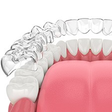 Illustration of crowded teeth