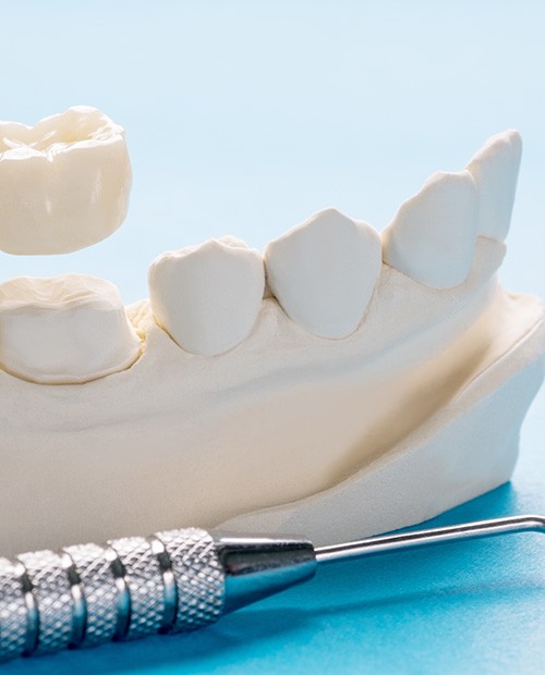 Sample dental crown on plaster teeth next to dental instrument