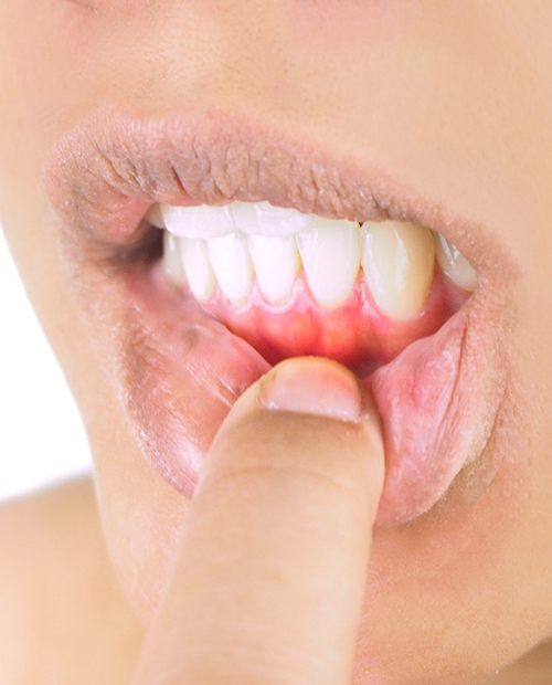 Pulling down lip to show symptoms of gum disease in Billerica, MA