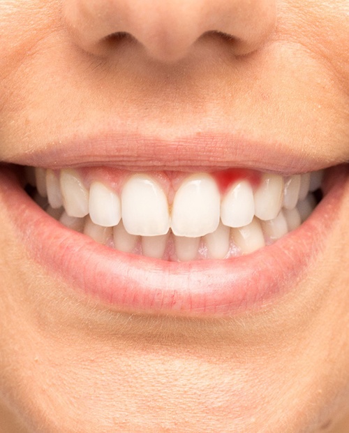 Close-up of smile with gums inflamed due to gum disease in Billerica, MA