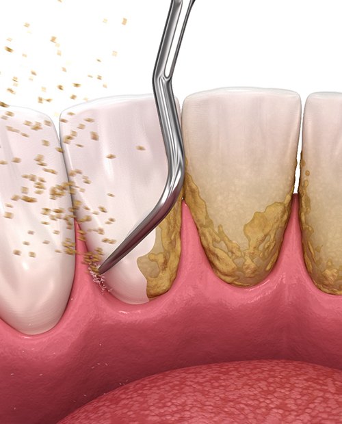 Illustration of scaling and root planing for treating gum disease in Billerica, MA